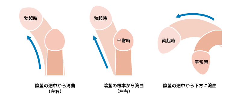 小陰唇のびらびらの色が黒いとお悩みの方へ【症例写真つき】｜スワンクリニック銀座