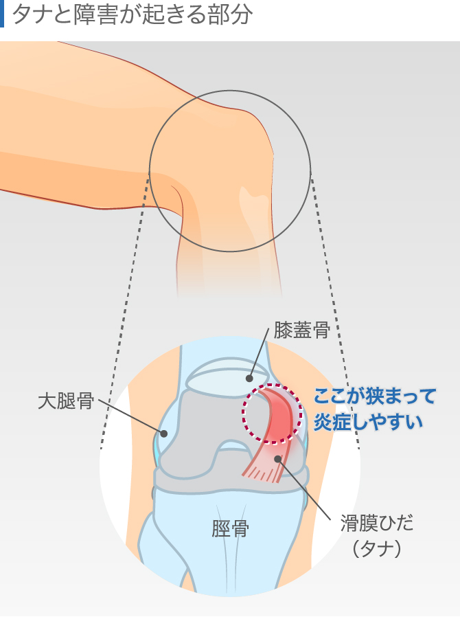 膝がカクッと抜けた感覚になると訴えられて来院されました。｜大阪府大東市の住道駅近くの『もり鍼灸整骨院』