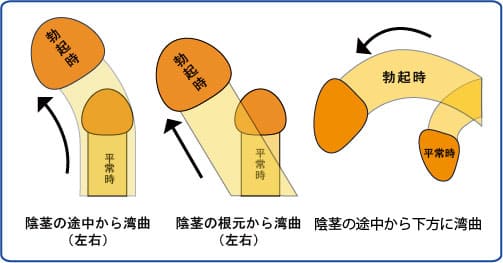 陰茎湾曲症の原因と手術について | 男性不妊治療は銀座リプロ外科